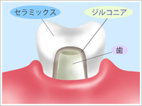 銀歯が気になる方へ