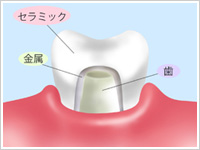 銀歯が気になる方へ