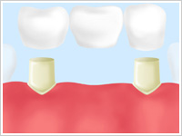 入れ歯を取り外すのが面倒な方へ～ブリッジ～