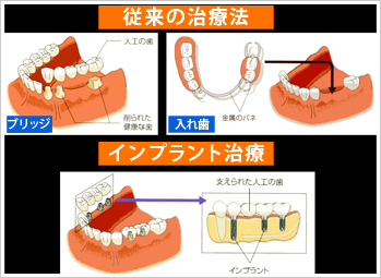 歯を失ってもインプラントがあります！