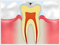 C0（虫歯になりかけの歯）