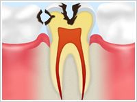 C2（象牙質の虫歯）