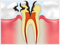C3（神経の虫歯）