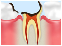 C4（歯根の虫歯）
